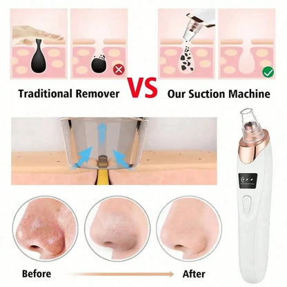 Professional Electric Blackhead Remover Vacuum - Pore Cleaner with 5 Suction Heads & USB Rechargeable Acne Pimple Extractor Kit