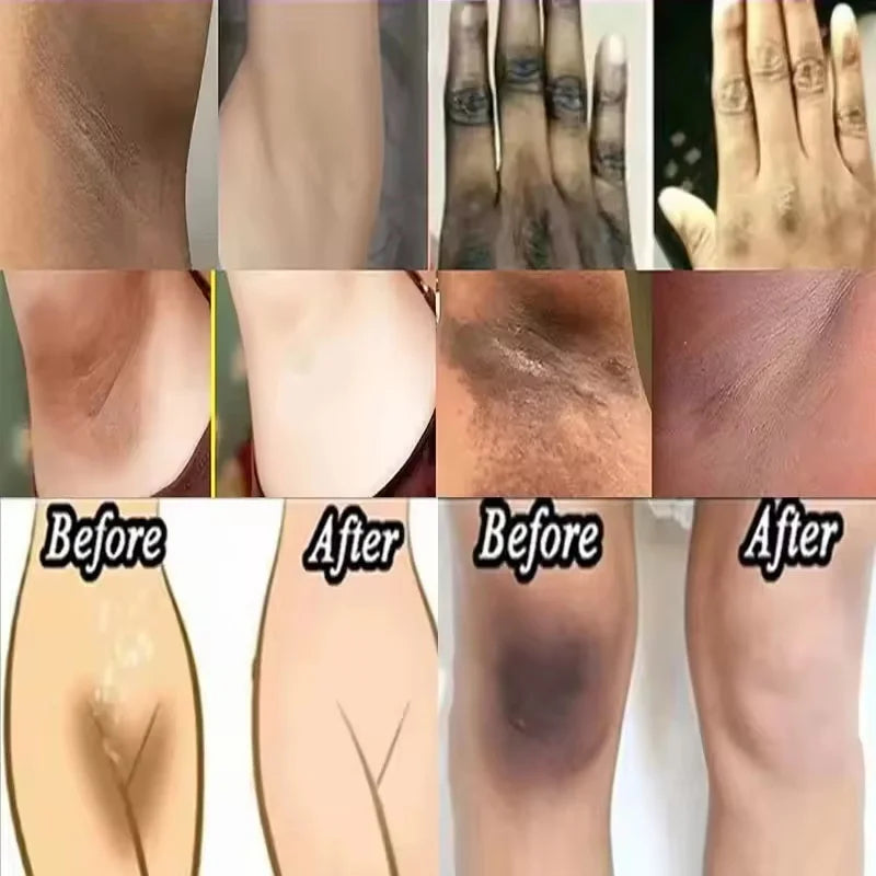 Intensive Whitening Cream for Sensitive Areas - Dark Skin Lightening & Bleaching Moisturizer for Underarms, Knees & Intimate Areas