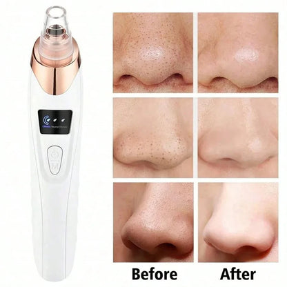 Professional Electric Blackhead Remover Vacuum - Pore Cleaner with 5 Suction Heads & USB Rechargeable Acne Pimple Extractor Kit
