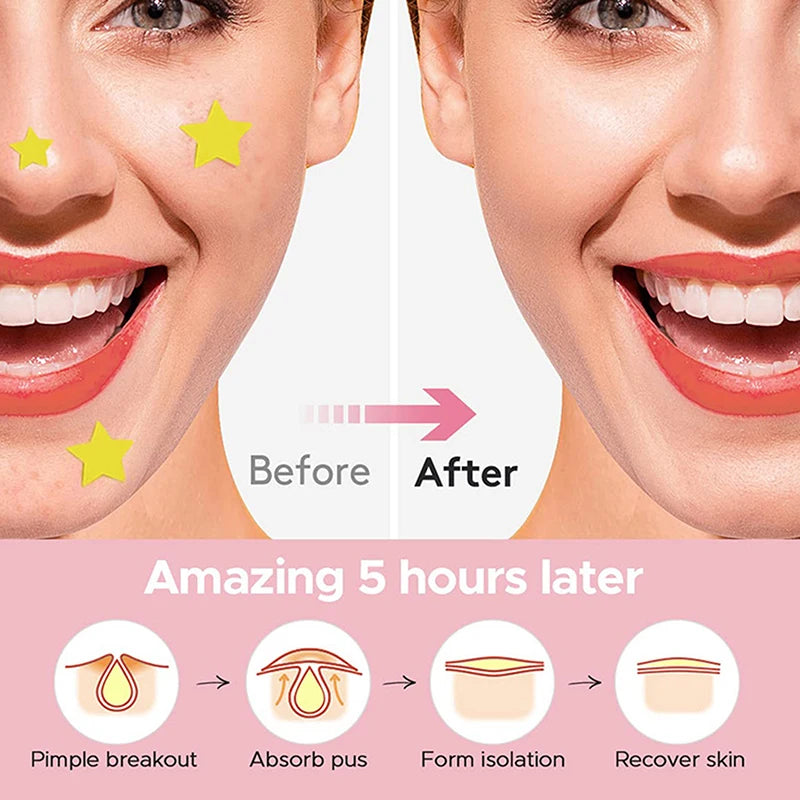 112 Pcs Star-Shaped Acne Pimple Patches - Colorful Hydrocolloid Skin Care Stickers for Spot Concealing & Fast Healing - Fun & Effective Acne Treatment